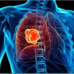 Καρκίνος του πνεύμονα: Γιατί έχει αυξηθεί στους μη καπνιστές - «Ήταν απόλυτο σοκ»