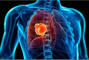 Καρκίνος του πνεύμονα: Γιατί έχει αυξηθεί στους μη καπνιστές - «Ήταν απόλυτο σοκ»